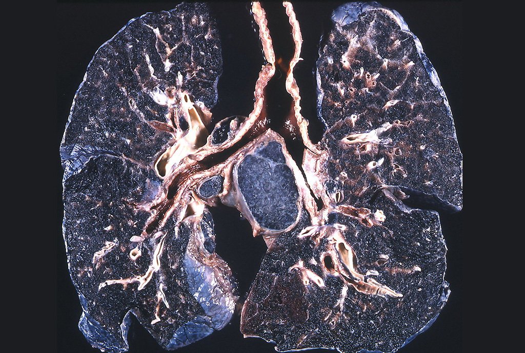 A lung showing black pigmentation and fibrosis due to inhalation of carbon pigment and silica respectively in a coal worker.