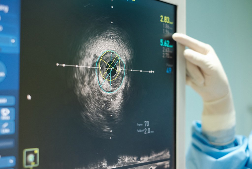 A screen shows intravascular ultrasound imaging at a cardiac facility. A laboratory tech’s hand points to data on the screen.