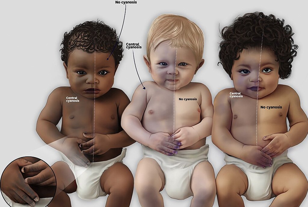 A medical illustration that illustrates three babies of varying skin tones and the discoloration effects that cyanosis can have on them. The illustration demonstrates different outcomes in the three babies, emphasizing the necessity of diversity in medical illustrations.