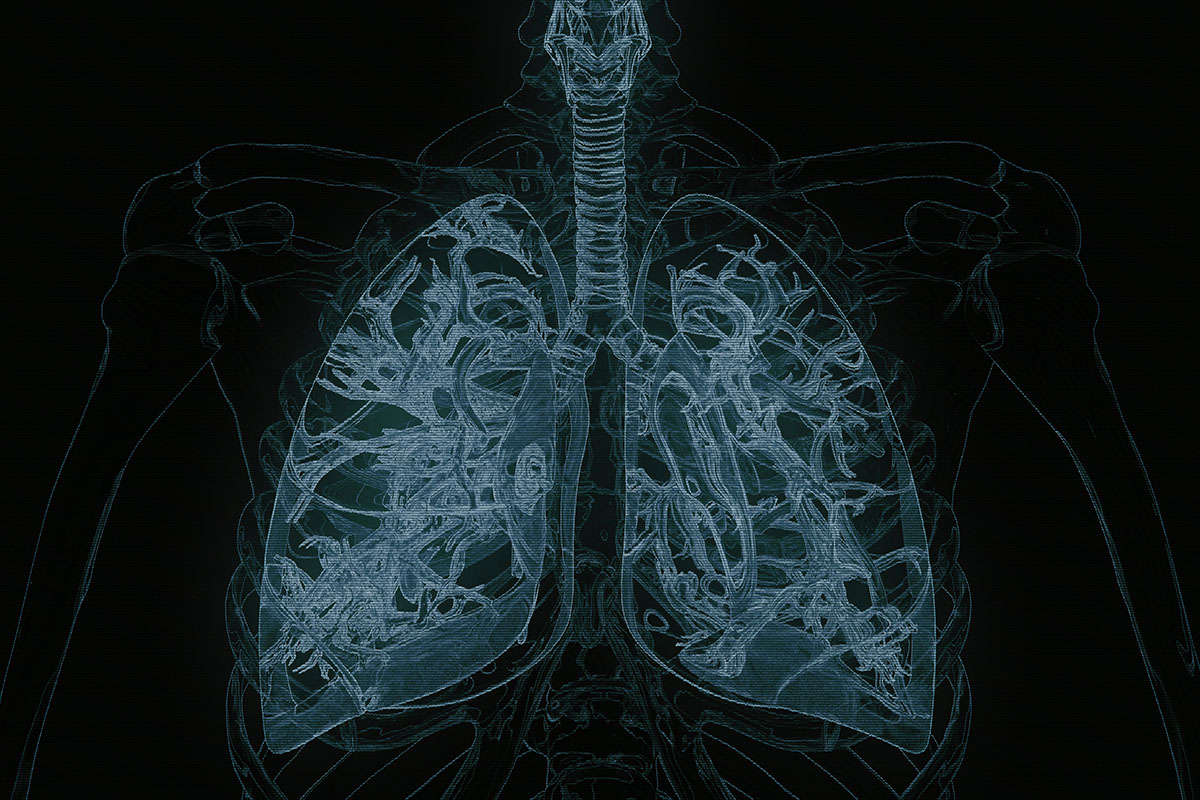 A black and white x-ray image of human lungs.