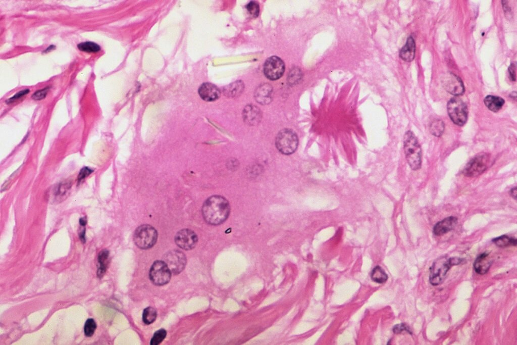 Pink microscope slide showing an asteroid body in sarcoidosis, with pink swirls of tissue speckled with fuschia orbs and a spiky, whispy substance.